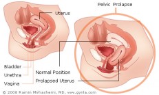 Procidentia Nedir