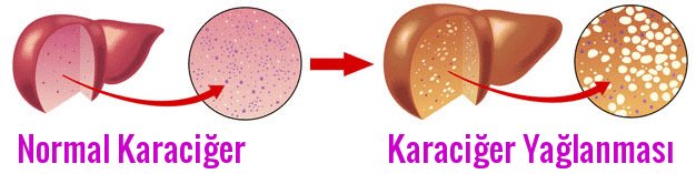 Karaciğer Neden Yağlanır Belirtileri Nelerdir ve Nasıl Tedavi Edilir